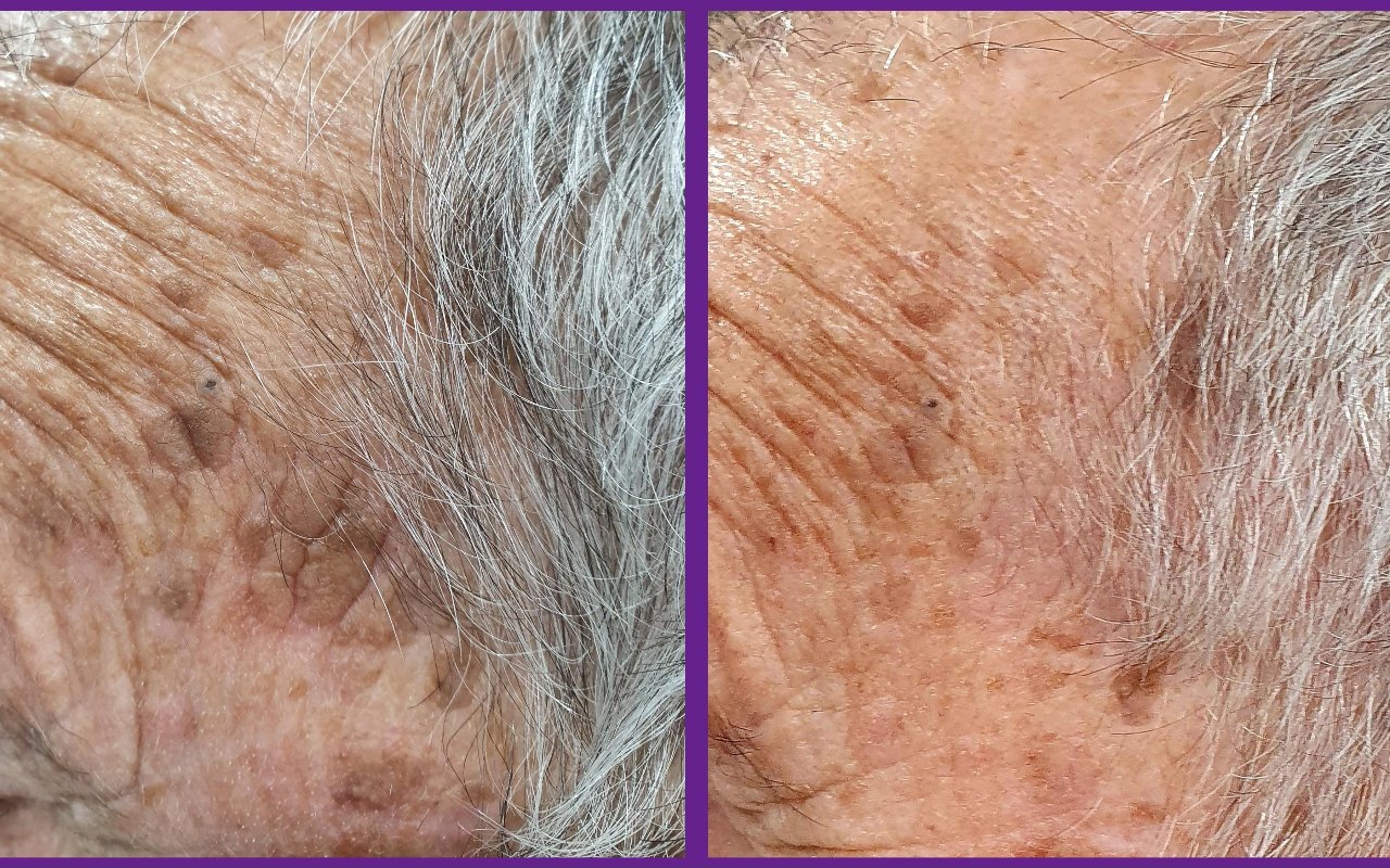 Before and after: age spot removal