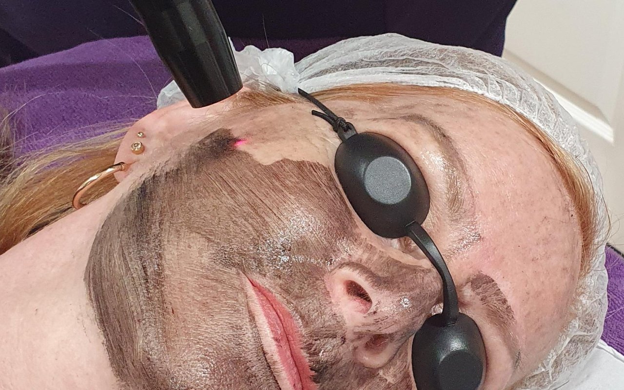 Carbon laser peel treatment in progress at the studio