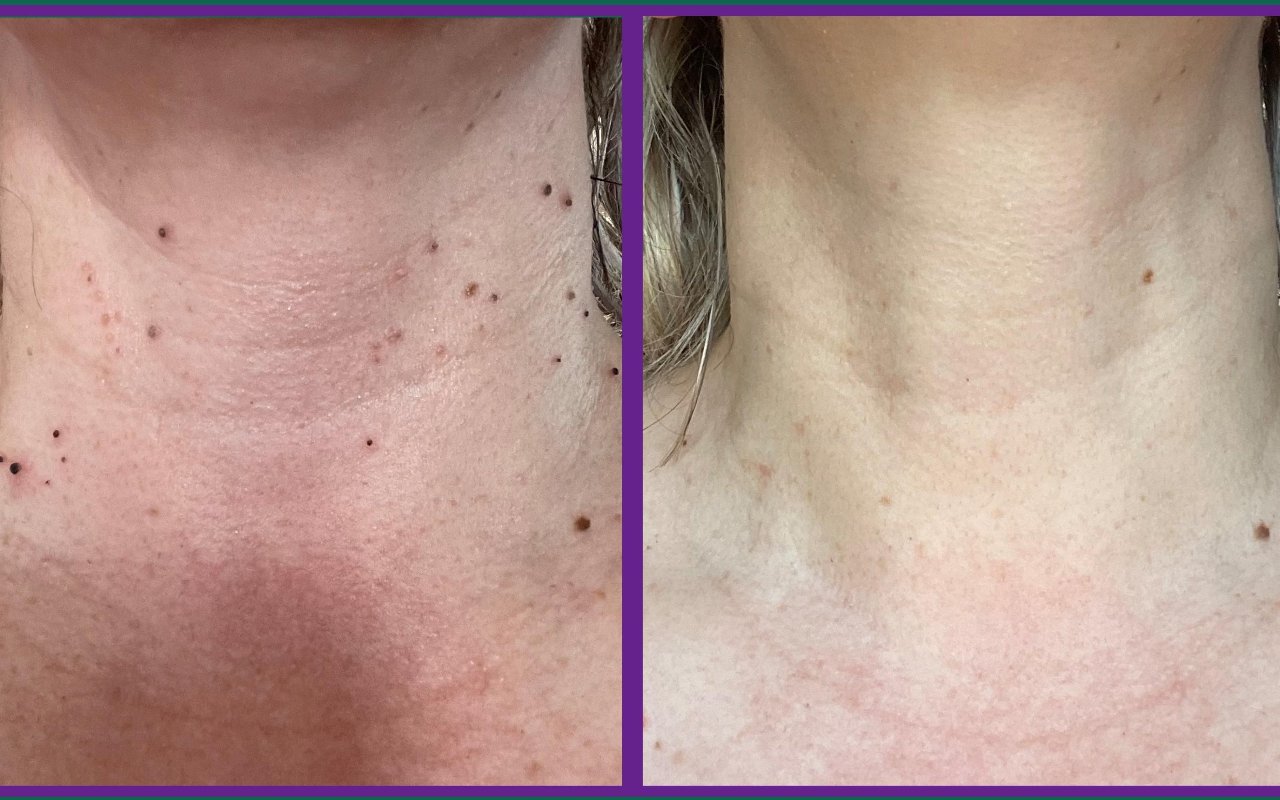 Before and after: skin tag removal on the neck